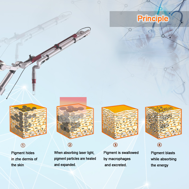 laser tattoo removal equipment equipo de eliminación de tatuajes con láser