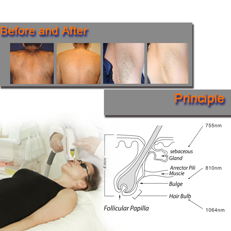 M&aacute;quina l&aacute;ser de diodo 8101