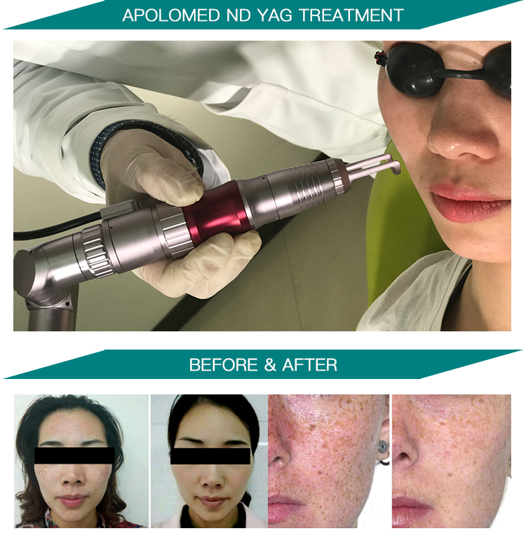 HS-298 antes y despu&eacute;s foto