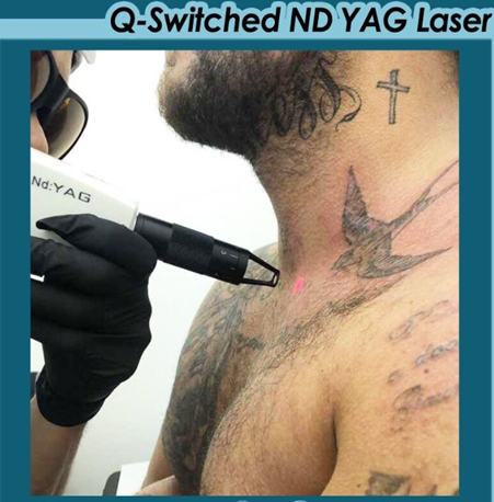 equipo l&aacute;ser qs 1