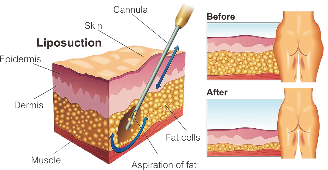 Pieza de mano de lip&oacute;lisis l&aacute;ser 
