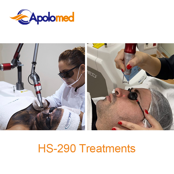 Tratamientos con m&aacute;quina l&aacute;ser Q-Swithced Nd YAG