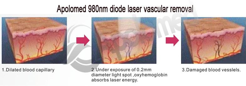 L&aacute;ser de diodo vascular de 980 nm.