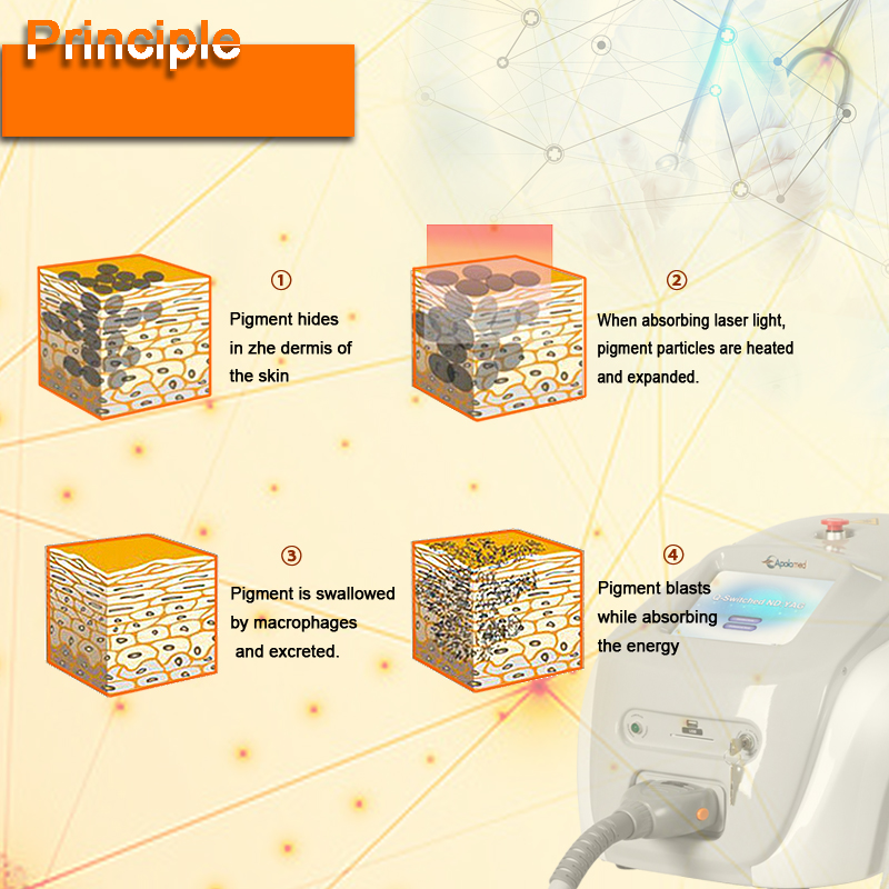 q cambiar la eliminaci&oacute;n de tatuajes 