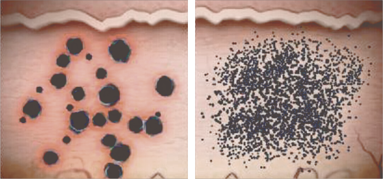 L&aacute;ser Tradicional