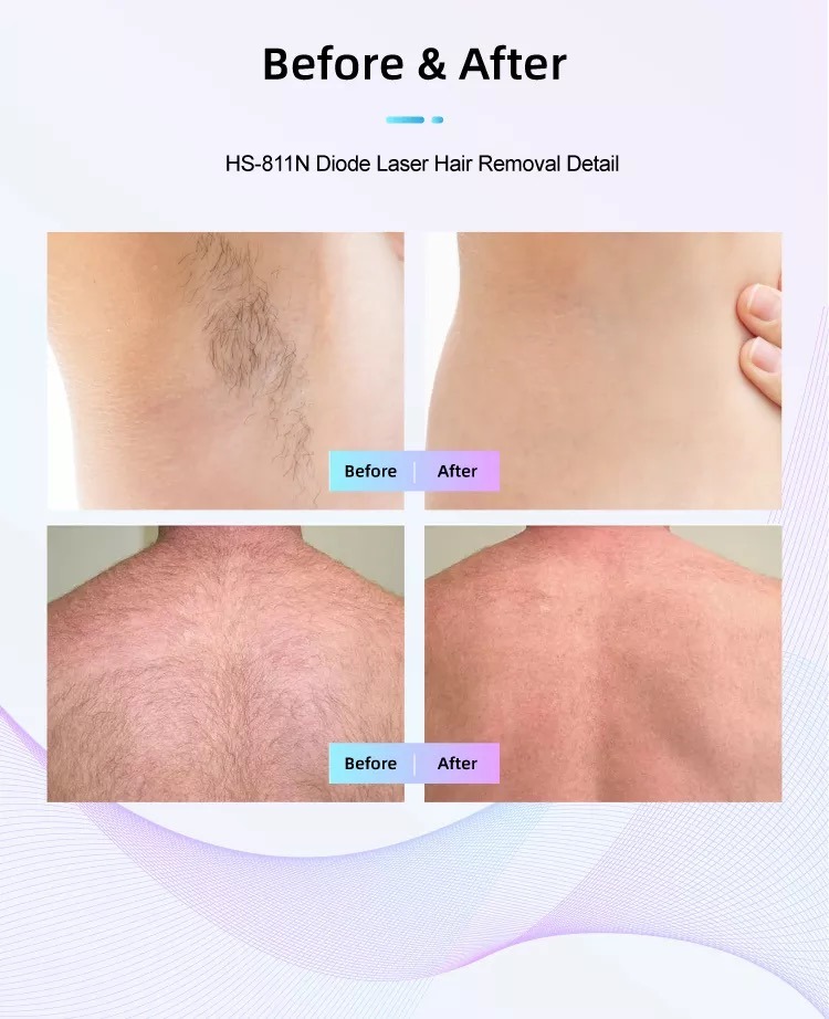 F&aacute;brica de m&aacute;quinas de depilaci&oacute;n l&aacute;ser de diodo HS-811
