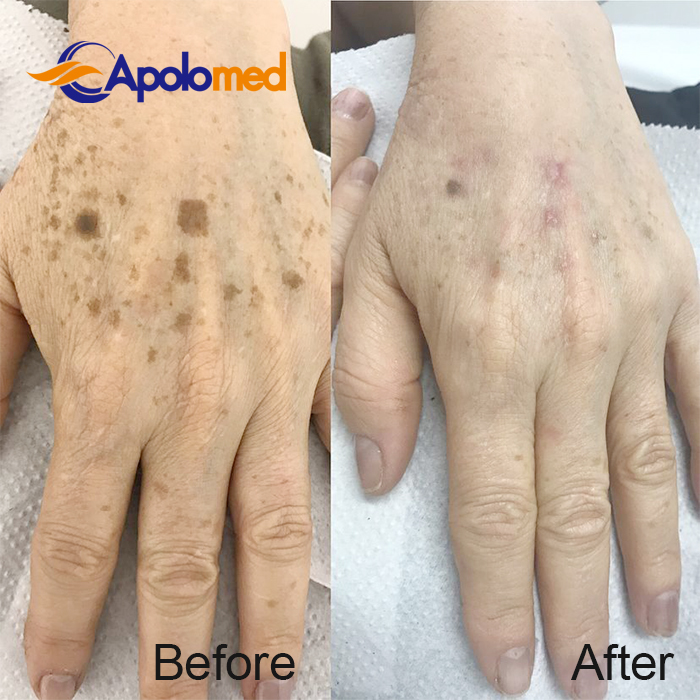 M&aacute;quina l&aacute;ser Q-Swithced Nd YAG antes despu&eacute;s