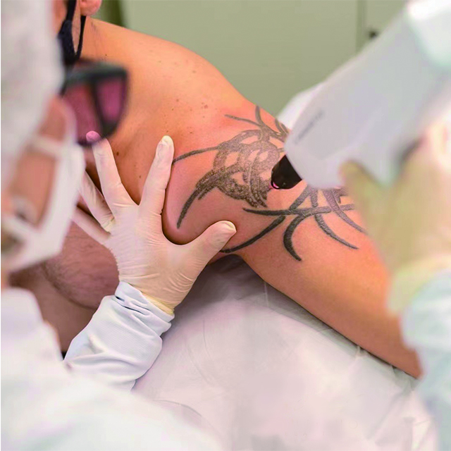 ¿Por qué es tan costosa la eliminación del láser del tatuaje?