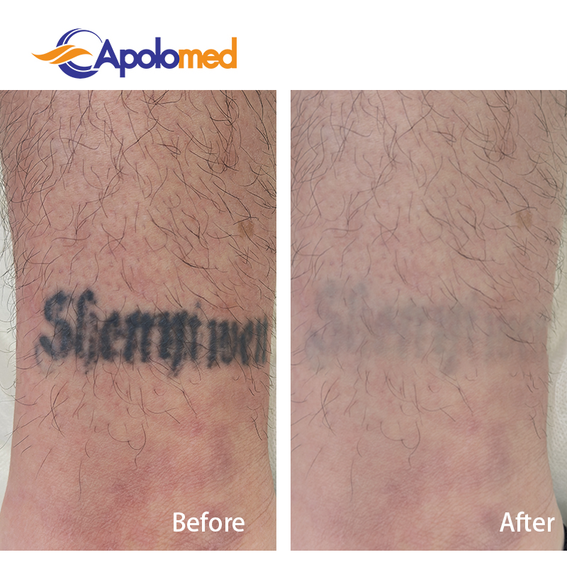 Tiempo de inactividad para la eliminación de tatuajes con láser: qué esperar después de cada sesión