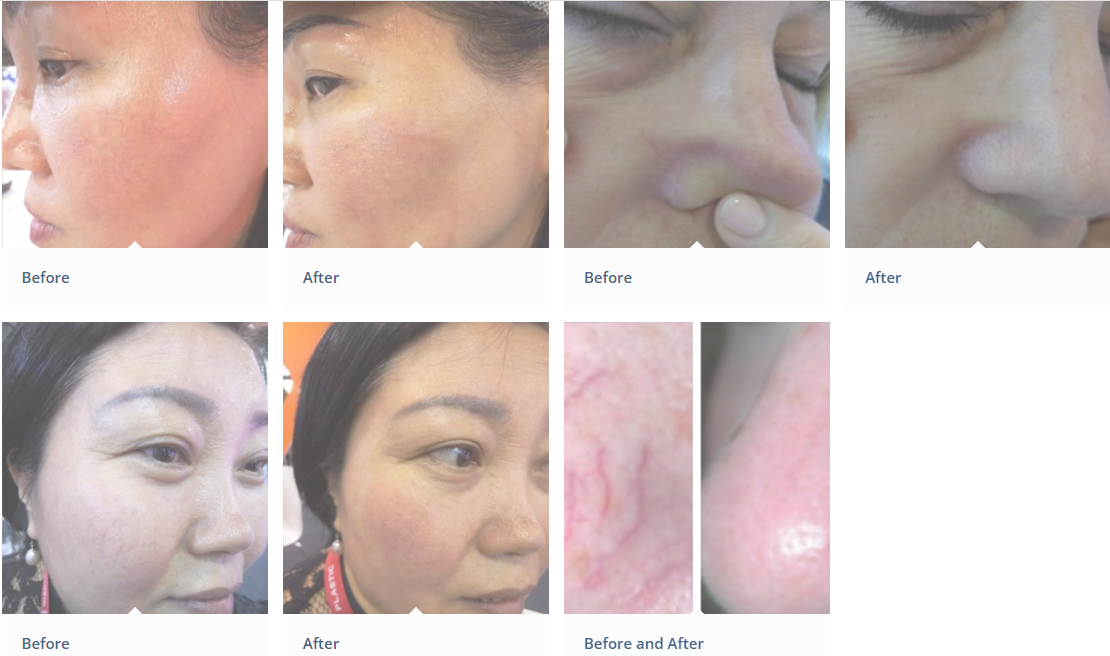 foto antes y despu&eacute;s