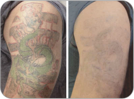 Antes y Despu&eacute;s 1 