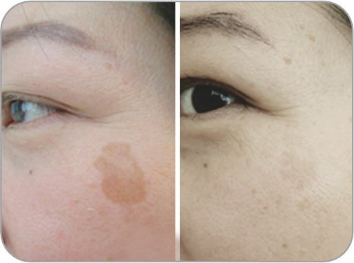 Antes y Despu&eacute;s 2