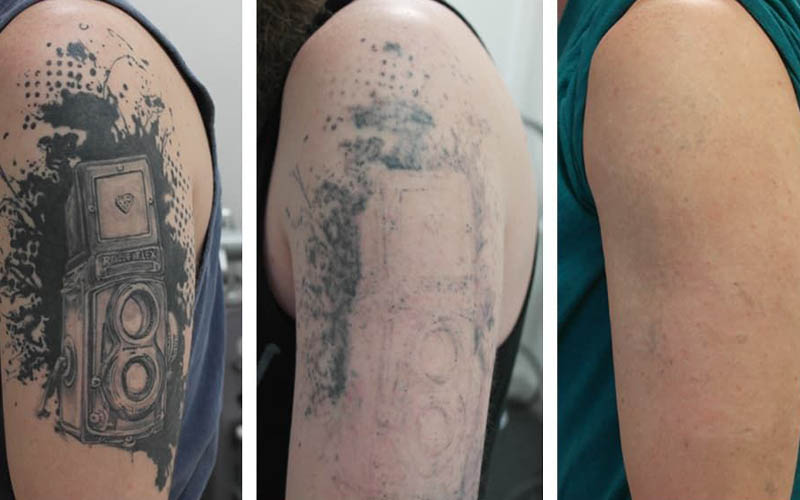 Formas de eliminar los tatuajes no deseados del cuerpo